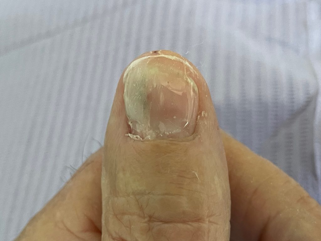 Een nagel na trauma operatie